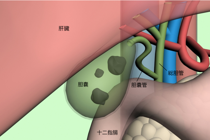 胆嚢 炎